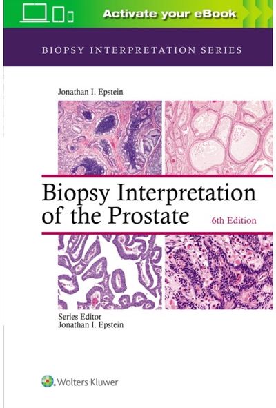 Biopsy
