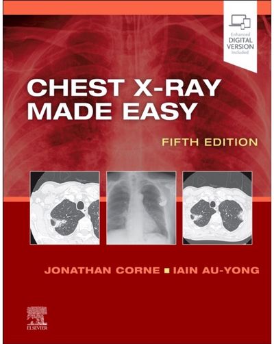 Chest X-Ray Made Easy